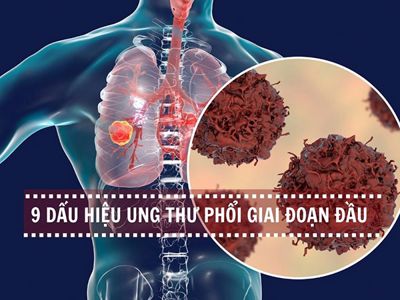 Cảnh giác 9 dấu hiệu ung thư phổi giai đoạn đầu chớ chủ quan